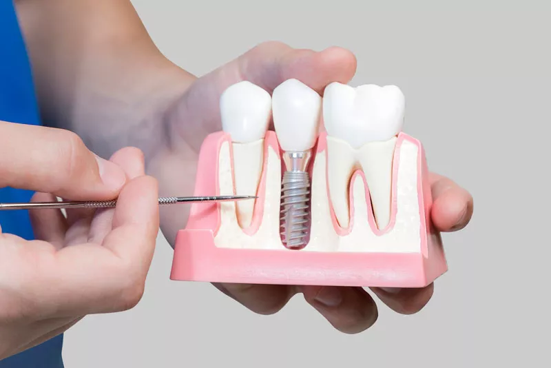 The Best Dental Implant Clinic in Dubai