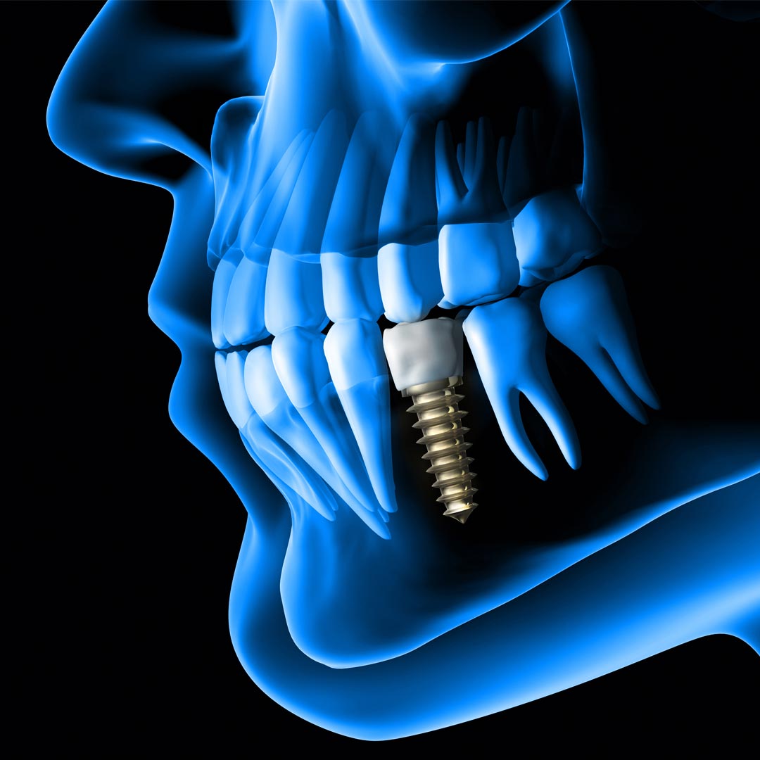 Dental Implant clinic in Dubai